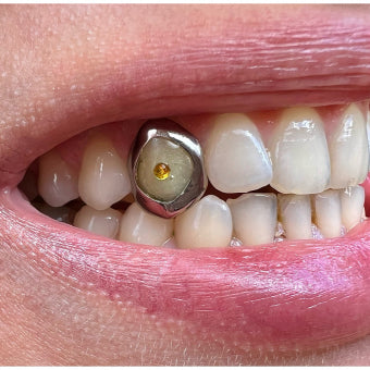 Acryl and Pearl Single Grillz