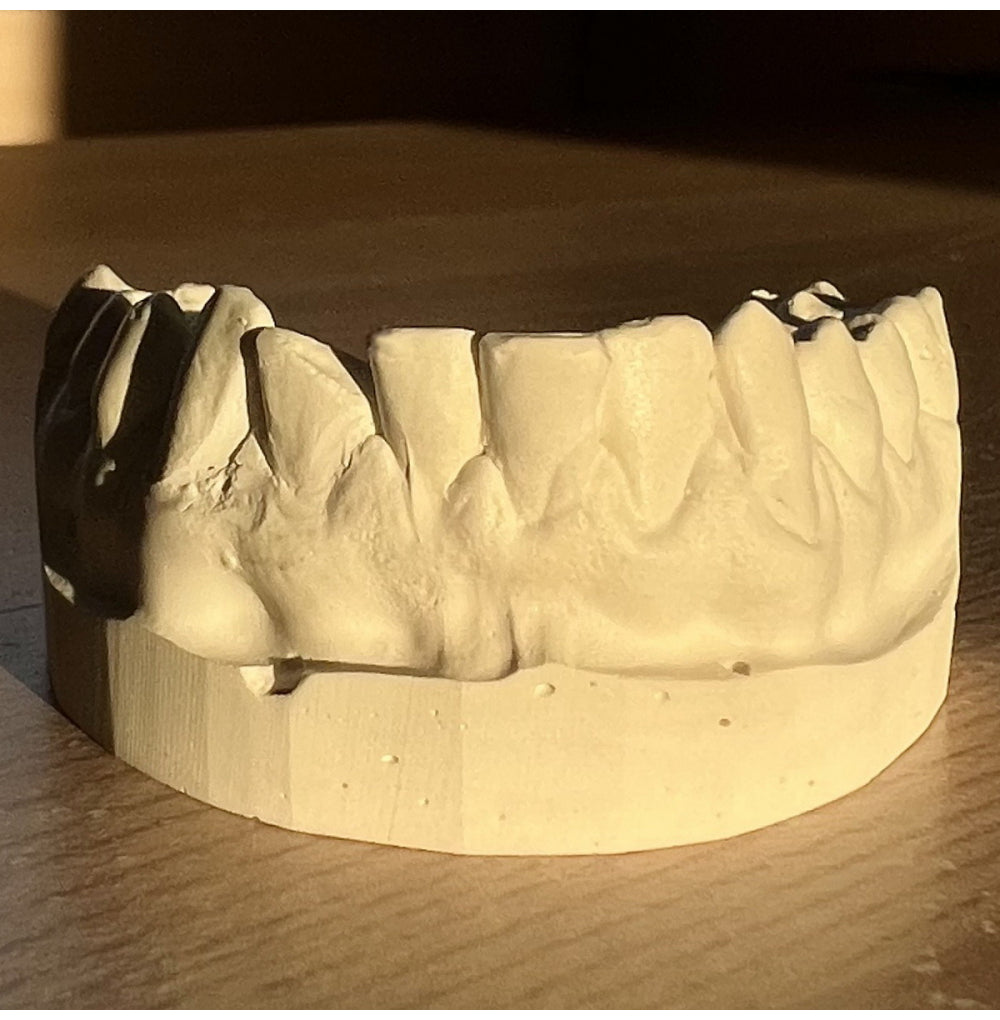 Broken Tooth Filler Custom Grillz