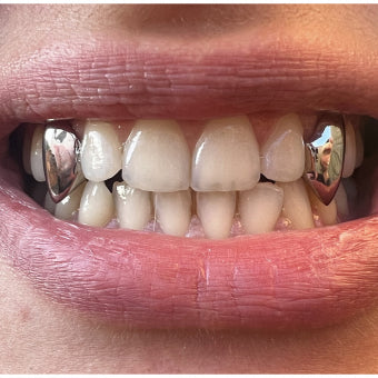 Close-up smile wearing Vampire Fangs 
