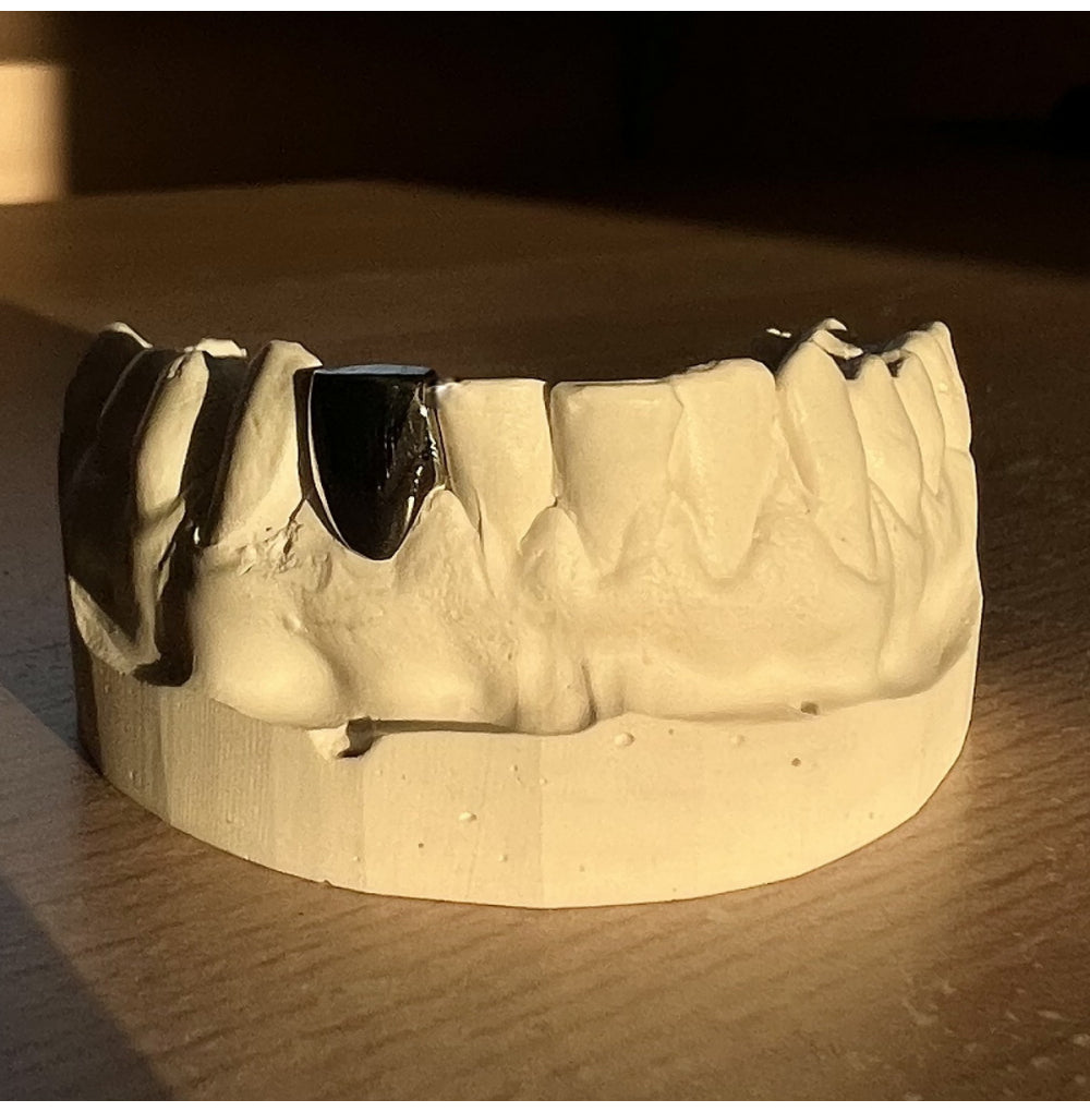 Broken Tooth Filler Custom Grillz